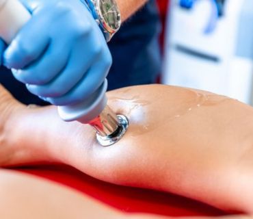 radial pressure wave therapy orange county ca radial pressure wave therapy orange county ca